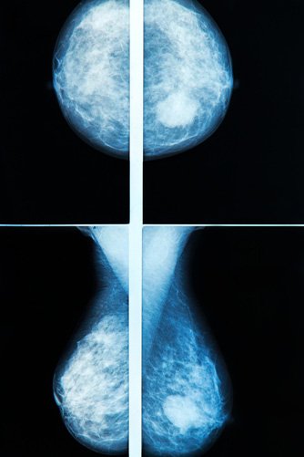 mamografia jelenia góra obrazowanie